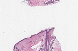 Intravascular Large B-Cell Lymphoma