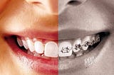 Braces vs. Invisalign — Which One is Right for You?