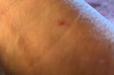 close up of author’s wrist with small scar