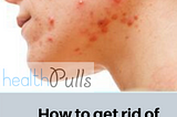 How to get rid of back acne at home- 6 Best Ways