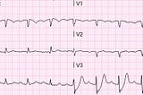 除了STE以外，還有哪些ECG sign也有可能血管阻塞呢?(前言)