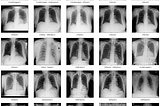 🧠 How I Accidentally Became a Medical AI Wizard (CheXNet, Kaggle GPUs & Pure Fear)