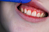 Can gum disease be reversed?