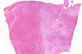 Splenic Infarct