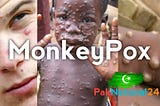 What Is Monkey Pox Virus?