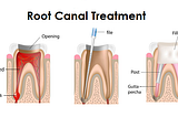 Root Canal Treatment Procedure | Dental clinic in delhi