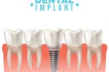 Everything You Need to Know About Dental Implants: From Procedure to Recovery
