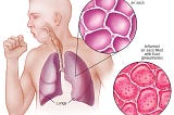 How to detect visual signals of Pneumonia using AI?