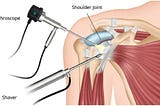 Here’s Everything to Know About Shoulder Arthroscopy