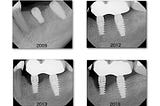 Treatment of Peri-Implantitis With Gum Grafting!