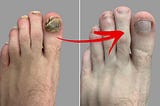 REAL cause of Toenail fungus revealed and How to Eliminate it in less than 14 Days