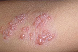 Cara Mengobati Herpes Di Tangan