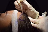 Why Hair Transplants Without Shaving are the Future of Hair Restoration