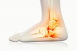 Ankle sprain