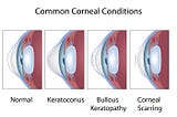 What are common conditions that affect the cornea?