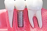 Can you get dental implants if you have receding gums?