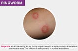 Signs and symptoms of ringworm