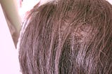 My Hair Loss Story — The Beginning