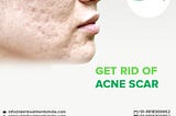 Get Best Acne Scar Treatment At — Skin Treatments India Clinic Visit Us