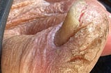 TOES