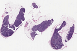 Toxoplasma Lymphadenitis-Like Changes in