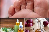 home remedies for athlete’s foot, athlete’s foot treatment, athlete’s foot symptoms, athlete’s foot home remedy, athlete’s foot pictures, natural