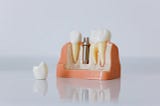 The Benefits of Dental Implants Compared to Dentures or Bridges