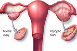 PCOS in women- Causes,  Myths , and Solutions