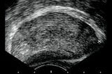 Prostate ultrasound