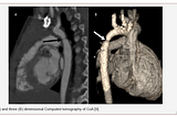 Iris Publishers-Anaesthesia & Surgery Open Access Journal | Predictive and Prognostic Value of…