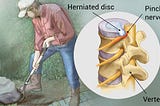 How I got through slipped/herniated disc injury