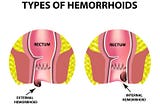 Hemorrhoids After Giving Birth: Prevalence and Causes