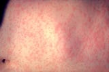 Measles — A Preventable Deadly Neurological and Respiratory Disease