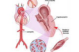 Dr. Ramji Mehrotra | Hypertensive Heart Disease