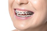 Smile Transformation: How Teeth Straightening Specialists in Vivekanand Nagar Can Help