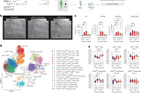 A multi-omic dataset was created from clinical blood tests (cl), scRNA-seq (SC), flow cytometry, cytokine assay (cy), plasma proteomics (p) and neutrophil (pmn) prime-seq. This was followed by MOFA model estimation and downstream analysis. Credit: Nature Medicine (2024). DOI: 10.1038/s41591–024–02953–4