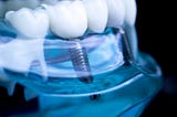 Eco-Friendly Dental Implants in 2024: Green Trends for a Sustainable Smile
