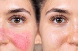 Understanding Rosacea Skin: Causes, Symptoms, Treatment, and Prevention