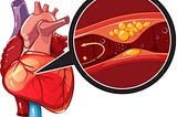 coronary artery disease