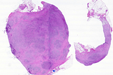 CHL, NS variant