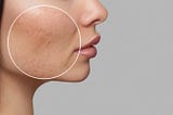 How to Minimize Large Pores: Causes, Prevention, and Effective Treatments