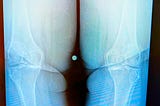 An X-ray image shows a clear view of two knee joints. The bones appear with distinct outlines against a dark background.