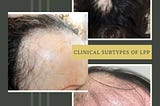 Cicatricial Alopecia: How Lichen Planopilaris Leads to Permanent Hair Loss — Understanding the Link