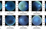 Ocular Disease Recognition using CNNs.