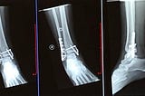 Broken Ankle Trimalleolar Fracture