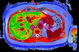Multiparametric Magnetic Resonance Imaging (MRI) as a Safe, Non-invasive Method for Assessing Liver…