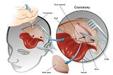 Craniotomy Surgery