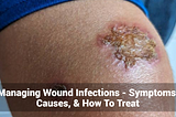 Managing Wound Infections — Symptoms, Causes, & How To Treat