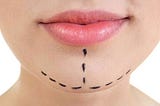 Who Are the Ideal Candidates for Chin Augmentation Surgery?