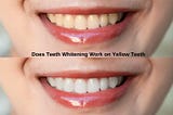 “Explore the effectiveness of teeth whitening on yellow teeth. Learn about professional treatments, dentist techniques, and home remedies. Discover the best options in Millbrae for a radiant smile.”